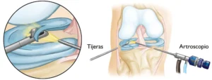 ARTROSCOPIA DE RODILLA