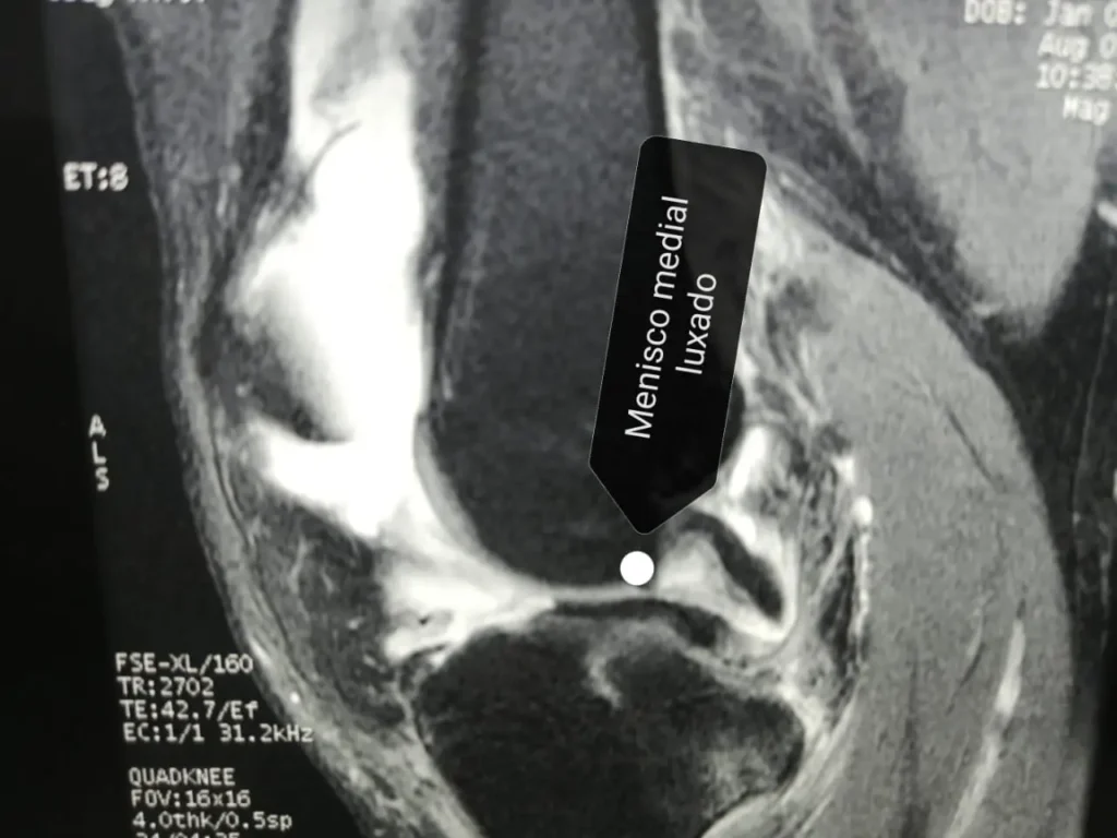 Menisco medial luxado 2