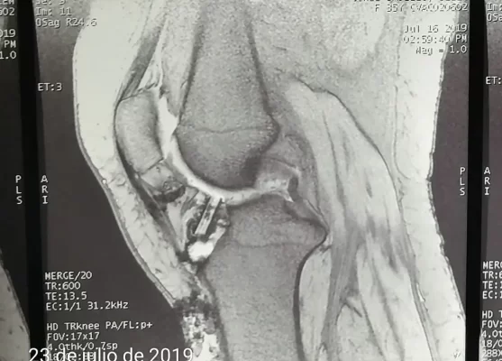 Cirugía fallida de LCA, por mala posición de tunel tibial-2